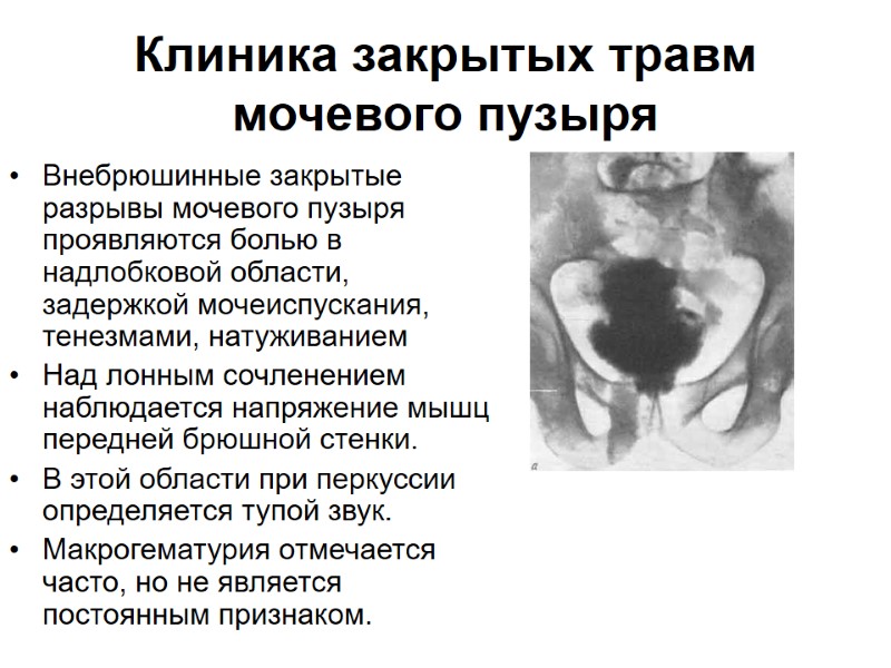 Клиника закрытых травм мочевого пузыря  Внебрюшинные закрытые разрывы мочевого пузыря проявляются болью в